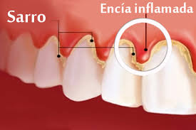  Remedios caseros para tratar y combatir la gingivitis